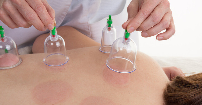 Cupping